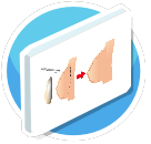 breast augmentation