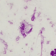Leishmaniasis