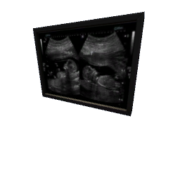 Twin Ultrasound