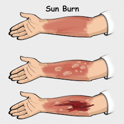 Sun Burn – Project Zomboid Mod