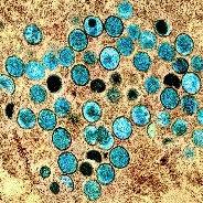 Mpox (monkeypox)