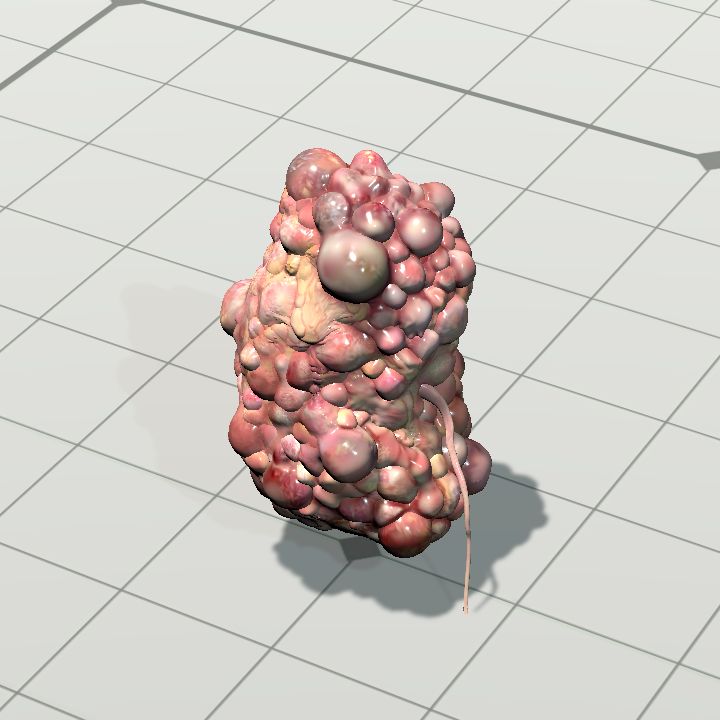 polycystic_kidney